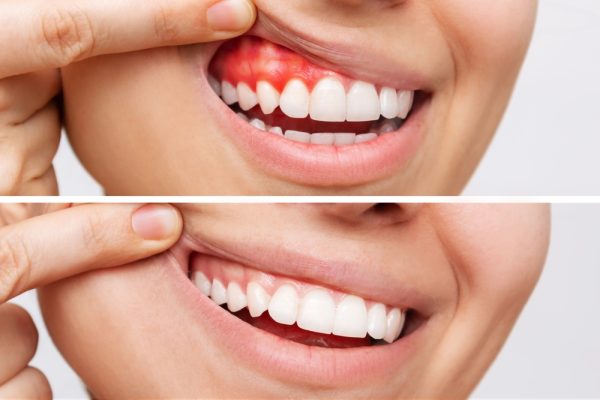 Gum recession how it works and treatments