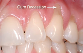 ækvator forsikring hende Gum Recession From Over Brushing - O'Halloran Hill Dental